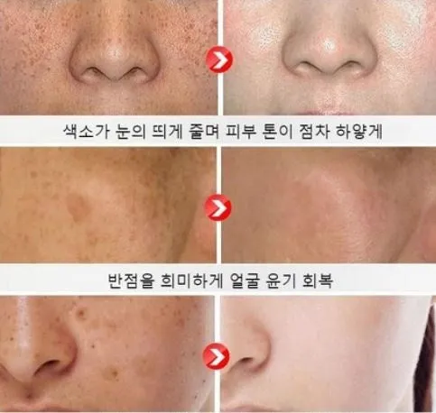 Kore lan Vita age spot removal cream age spot blemishes, 20ml