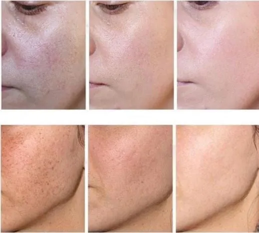 Kore lan Vita age spot removal cream age spot blemishes, 20ml